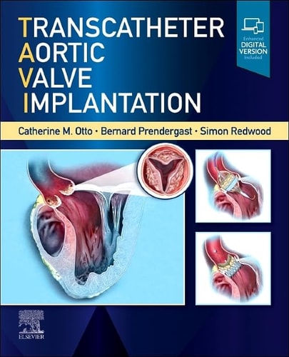 Transcatheter Aortic Valve Implantation cover