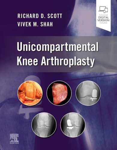 Unicompartmental Knee Arthroplasty cover