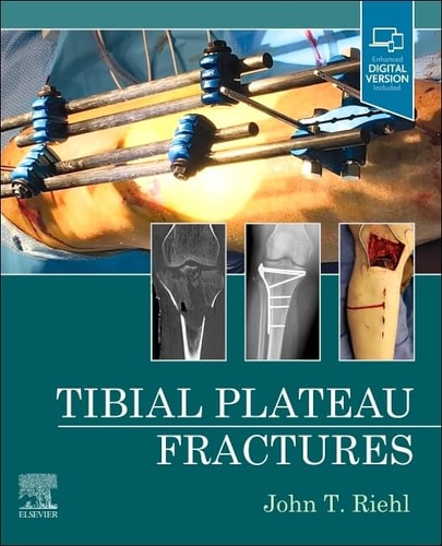 Tibial Plateau Fractures cover