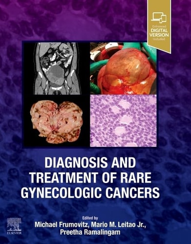 Diagnosis and Treatment of Rare Gynecologic Cancers cover