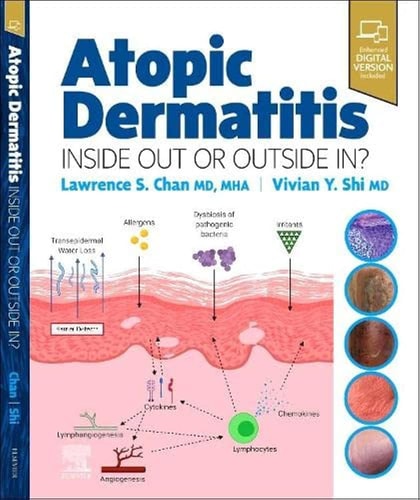 Atopic Dermatitis: Inside Out Or Outside In cover
