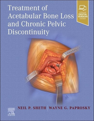 Treatment of Acetabular Bone Loss and Chronic Pelvic Discontinuity cover