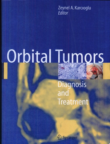 Orbital Tumors Diagnosis And Treatment cover