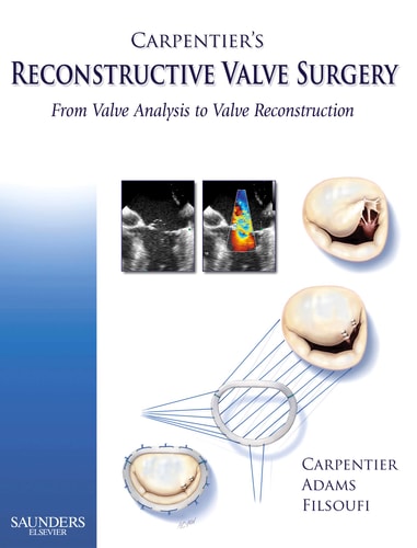Carpentier's Reconstructive Valve Surgery From Valve Analysis to Valve Reconstruction cover