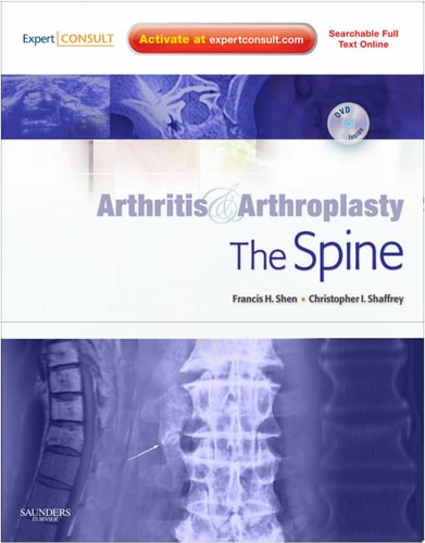 Arthritis and Arthroplasty The spine cover