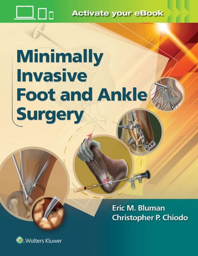 Minimally Invasive Foot and Ankle Surgery cover