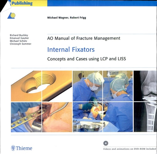 Internal Fixators Concepts and Cases Using LCP and LISS cover