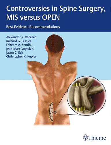 Controversies in Spine Surgery, MIS Versus OPEN Best Evidence Recommendations cover