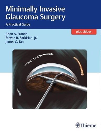 Minimally Invasive Glaucoma Surgery A Practical Guide cover