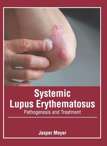 Systemic Lupus Erythematosus: Pathogenesis and Treatment cover