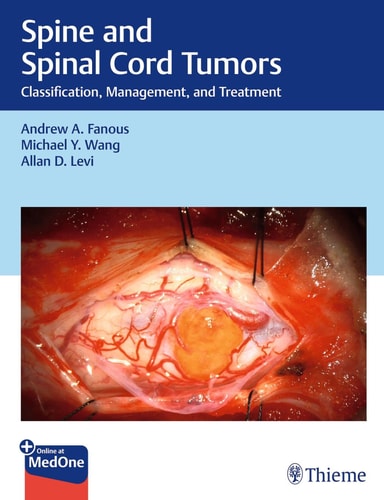 Spine and Spinal Cord Tumors Classification, Management and Treatment cover