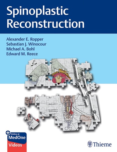Spinoplastic Reconstruction cover
