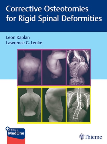 Corrective Osteotomies for Rigid Spinal Deformities cover