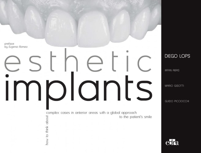 Esthetic Implants. How to Think about Complex Cases in Anterior Areas with a Global Approach to the Patient' S Smile cover